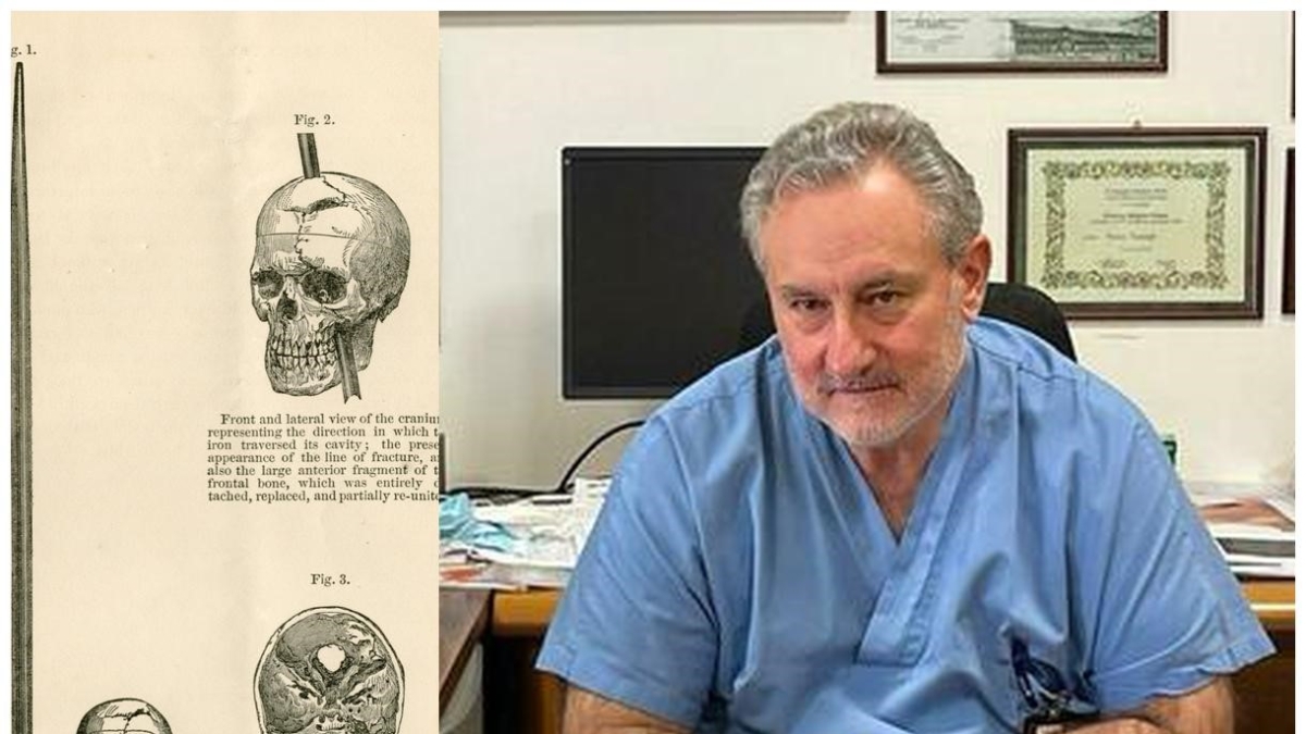 Sopravvive per due giorni con una freccia nel cervello. Il primario: «In ospedale lucido e con gli occhi aperti, operato con i trucchi dei chirurghi militari»