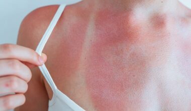 Sunburn challenge, il trend dell'abbronzatura selvaggia sui social: i rischi delle ustioni, come evitarli e i rimedi. «Ecco come capire quando bisogna fermarsi»