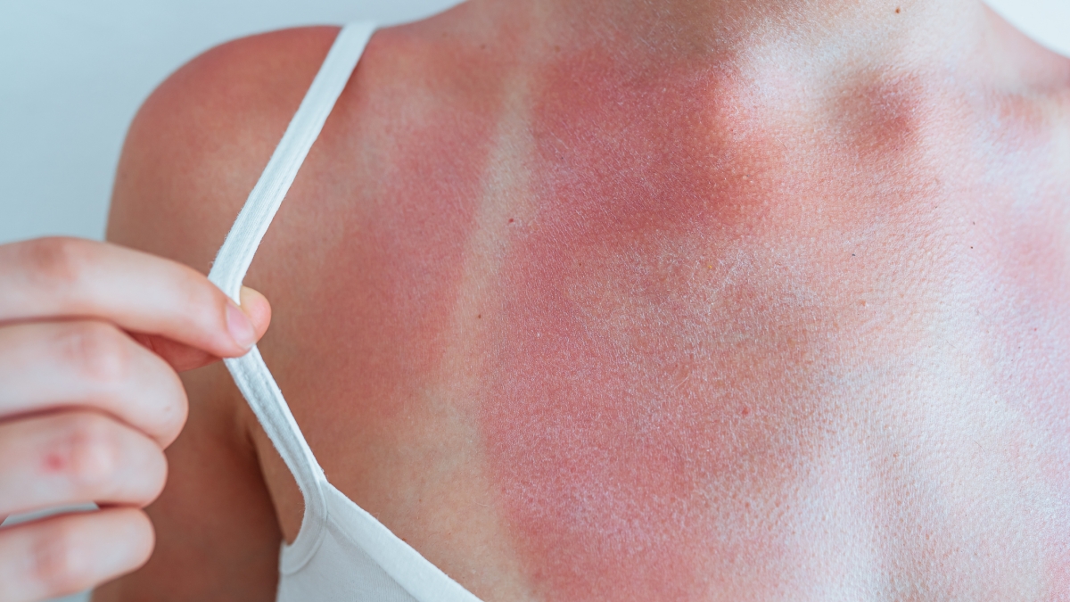 Sunburn challenge, il trend dell'abbronzatura selvaggia sui social: i rischi delle ustioni, come evitarli e i rimedi. «Ecco come capire quando bisogna fermarsi»