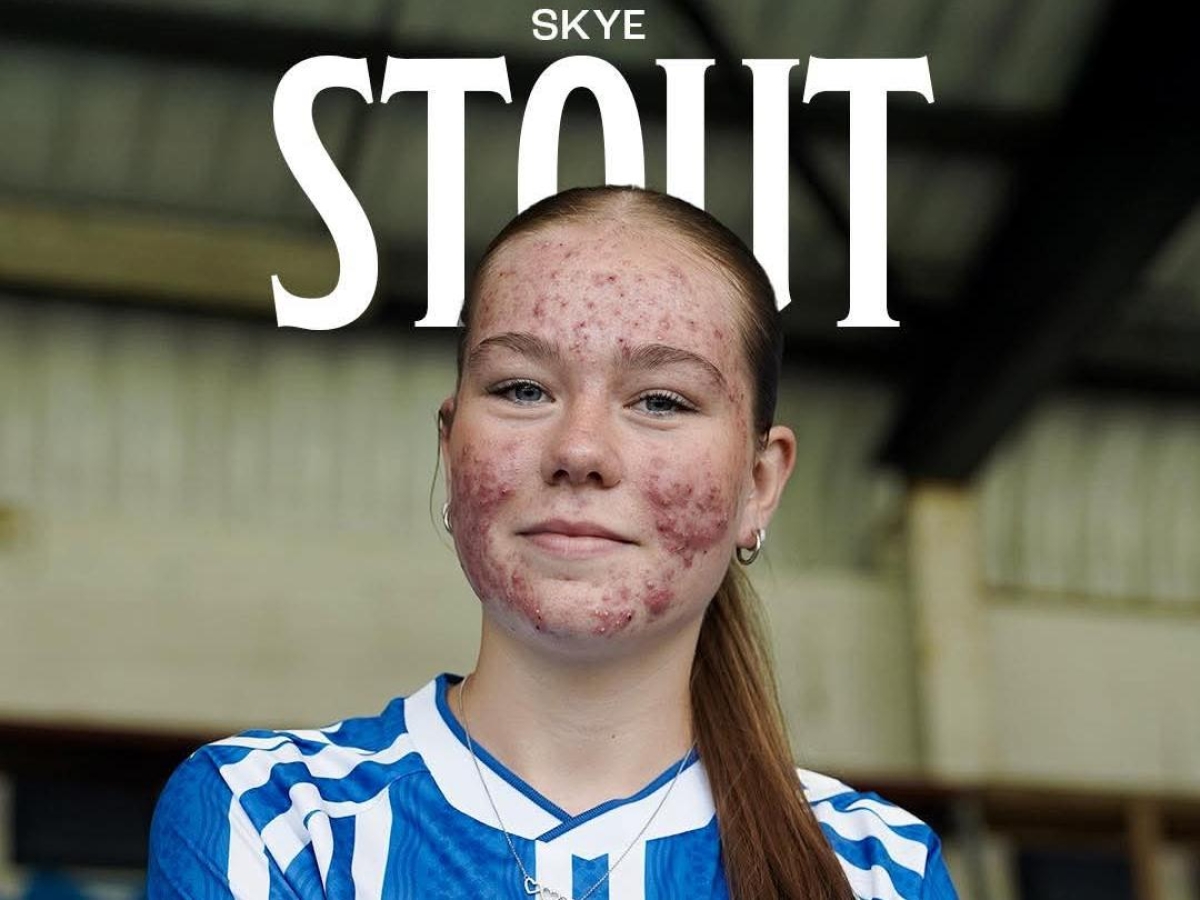 Calcio femminile, 16enne ingaggiata dal Kilmarnock viene insultata per via dell'acne: il club toglie l'annuncio dai social