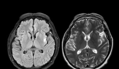 Alzheimer, la dieta mediterranea può «compensare» il rischio genetico di ammalarsi