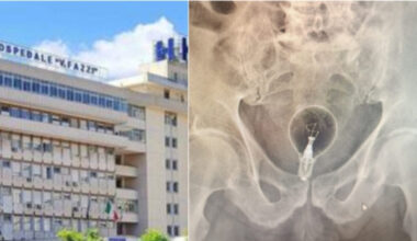 Lecce, anziano di 85 anni al pronto soccorso: «Ho una lampadina nel retto»