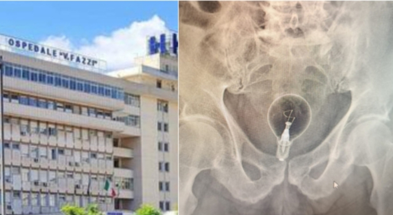 Lecce, anziano di 85 anni al pronto soccorso: «Ho una lampadina nel retto»