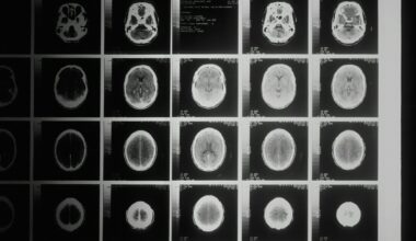 Tumore al cervello, una nuova terapia