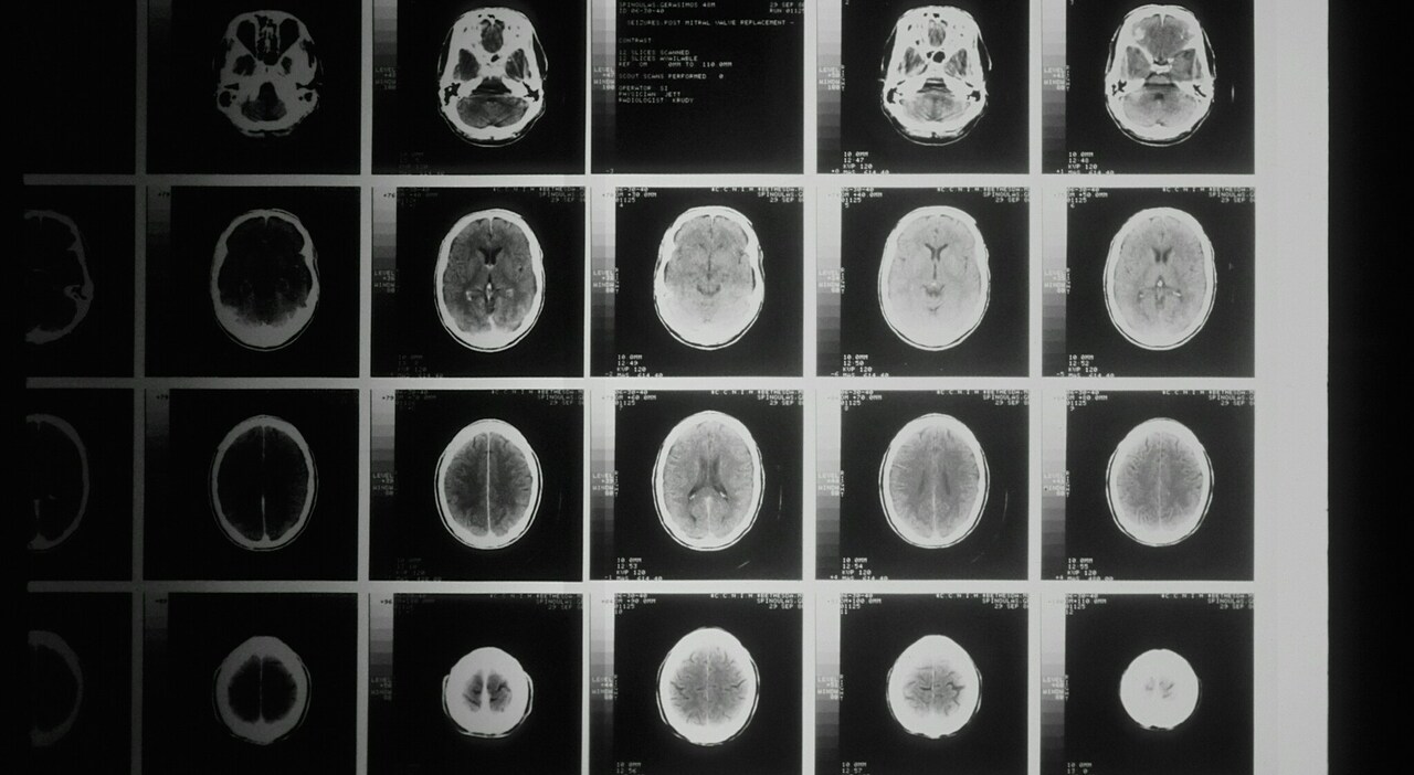 Tumore al cervello, una nuova terapia