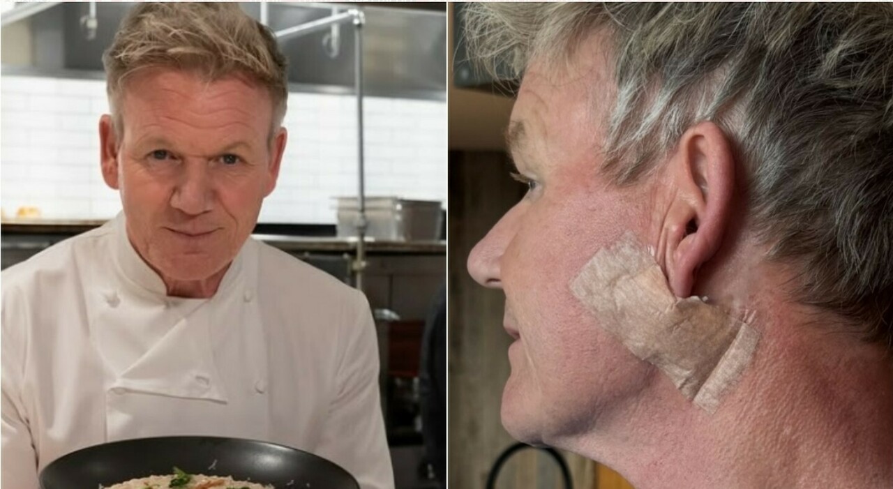 Gordon Ramsay scopre un tumore alla pelle sul collo: «Mi sono operato, usate sempre la crema solare». E mostra la cicatrice - Il Messaggero