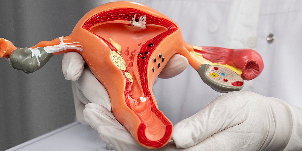 Endometriosi, un universo di storie: la sfida di decifrarle con la ricerca molecolare