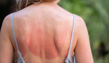 Il ministero della Salute valuta contromisure contro le challenge social sulle scottature - alanews