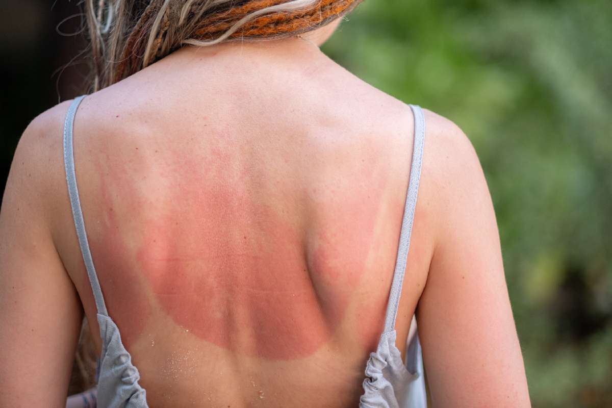 Il ministero della Salute valuta contromisure contro le challenge social sulle scottature - alanews