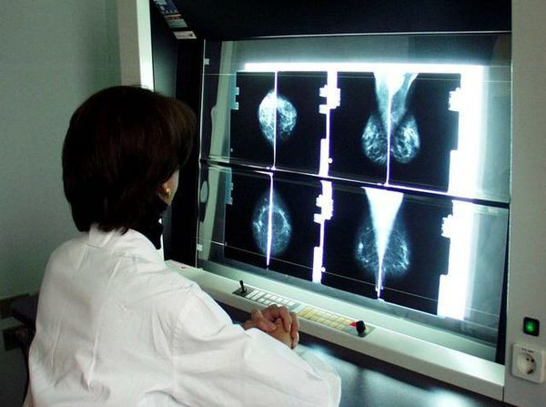 Tumori seno, 50 diagnosi "perse" a causa del Covid. Si punta a 30mila esami