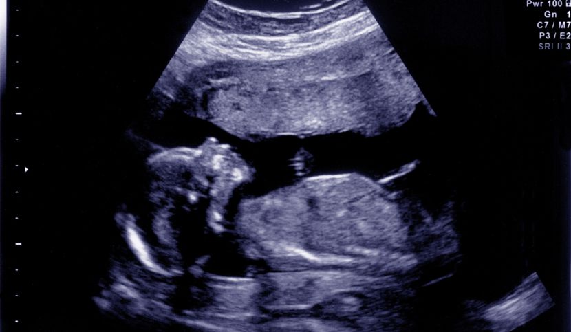 malformazioni-del-feto