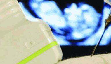 Gemelli morti dopo l'amiocentesi a Torino: chiesta condanna per il medico