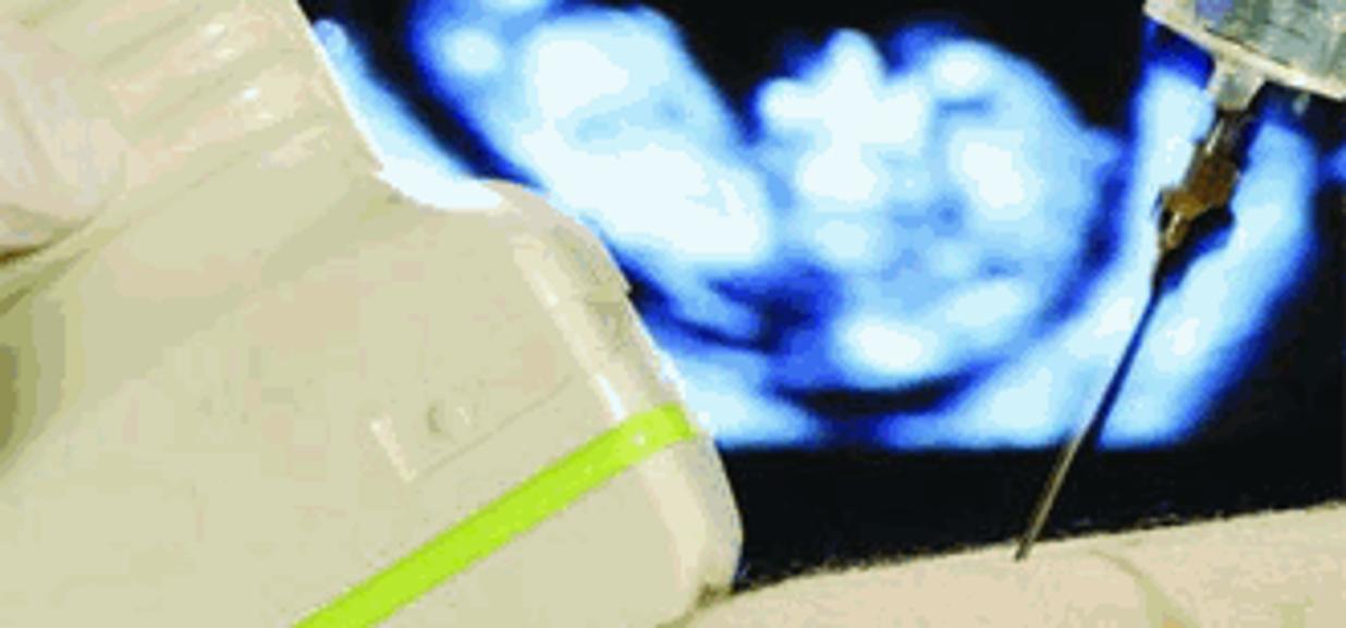 Gemelli morti dopo l'amiocentesi a Torino: chiesta condanna per il medico