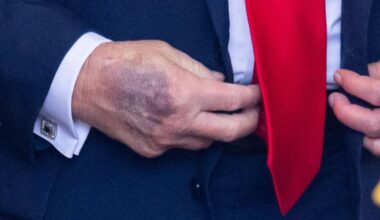 Il livido sulla mano di Trump cosa significa? Quali problemi di salute può svelare?