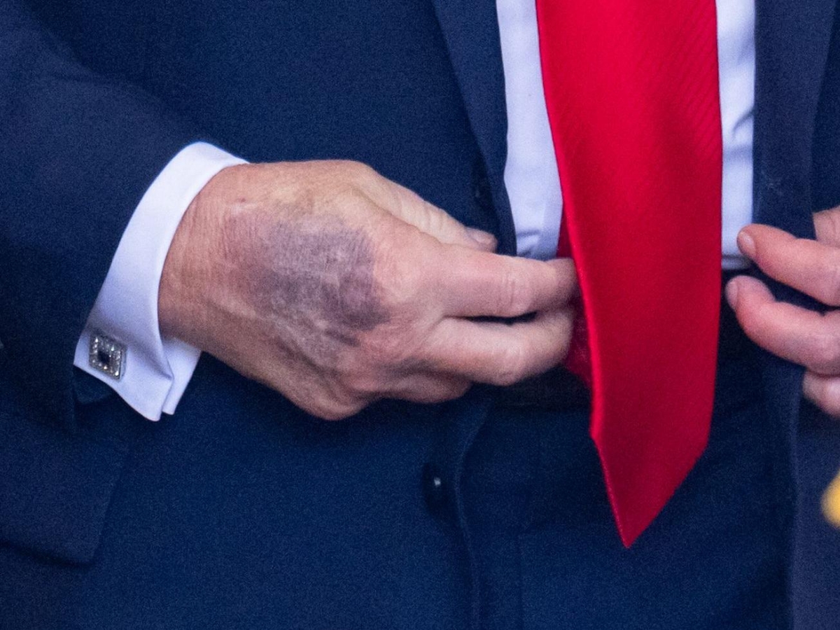 Il livido sulla mano di Trump cosa significa? Quali problemi di salute può svelare?