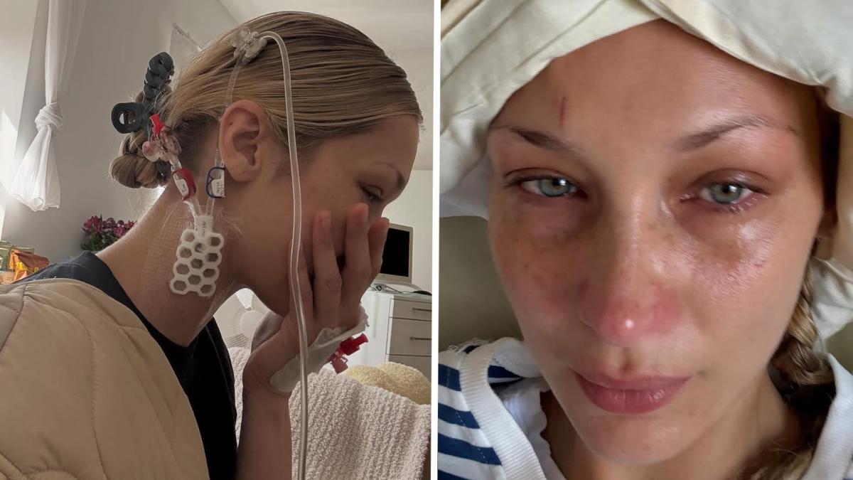 Bella Hadid in ospedale per Malattia di Lyme: le foto shock