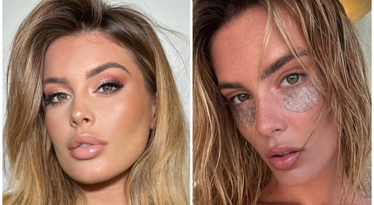 «Da adolescente avevo la dismorfia, mi vergognavo. Il primo filler a 16 anni, ora sono tornata naturale»