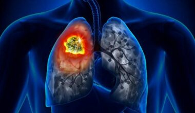 i morti di cancro supereranno i 18 milioni nel 2050 (+75%), lo studio su Lancet. Dal fumo alla dieta, come prevenirli