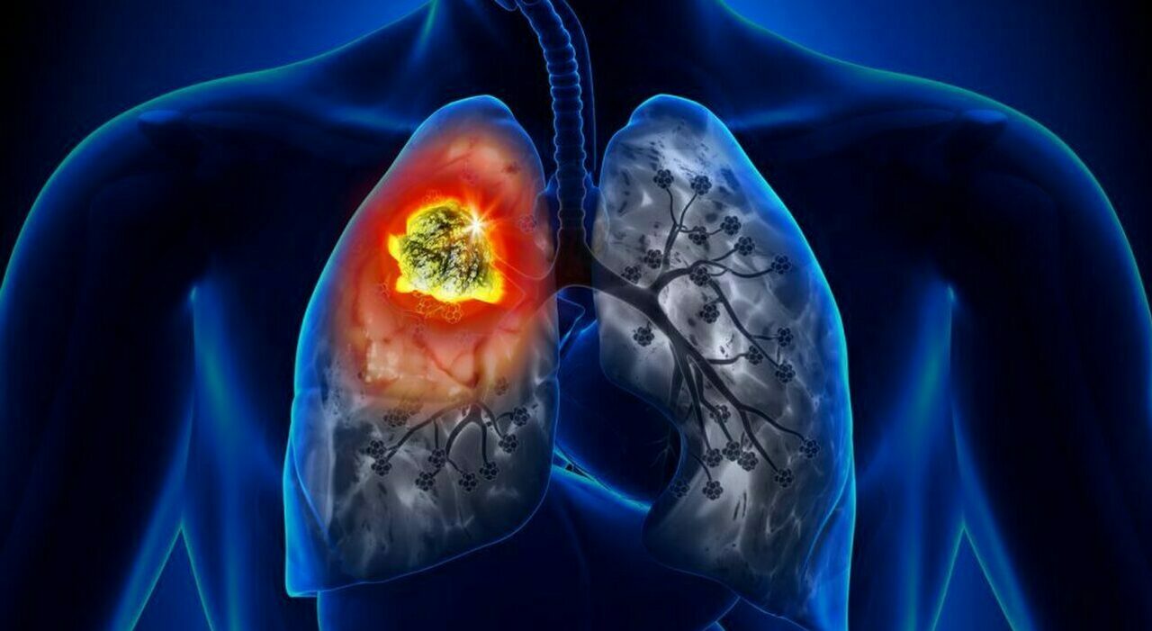 i morti di cancro supereranno i 18 milioni nel 2050 (+75%), lo studio su Lancet. Dal fumo alla dieta, come prevenirli
