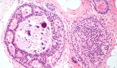 Il ruolo della proteina NONO nella lotta al carcinoma mammario. Lo studio del Pascale apre nuove prospettive di cura