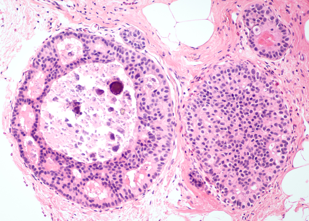 Il ruolo della proteina NONO nella lotta al carcinoma mammario. Lo studio del Pascale apre nuove prospettive di cura