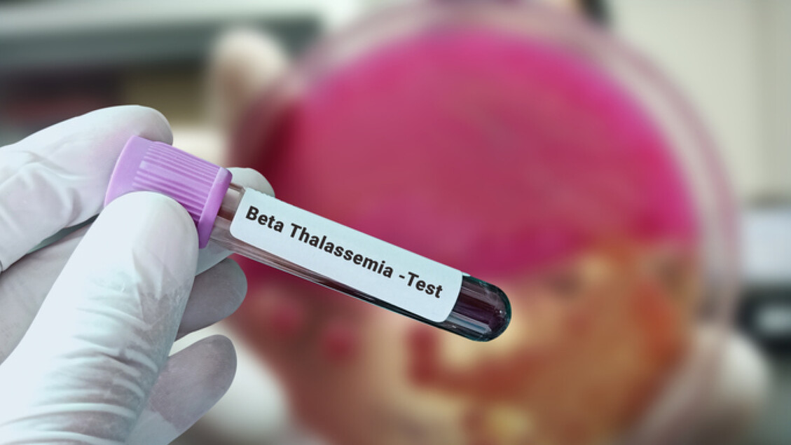Rimborso a terapia genetica per β-talassemia e anemia falci - Medicina