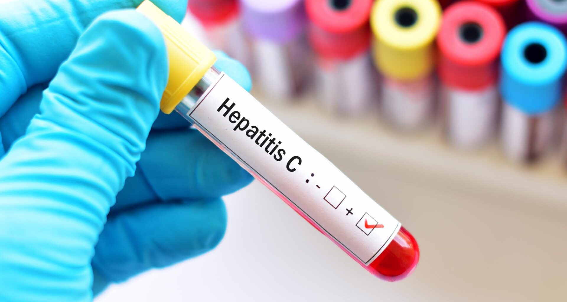 Trapianti: sì all’utilizzo di organi da donatori con Epatite C su riceventi negativi