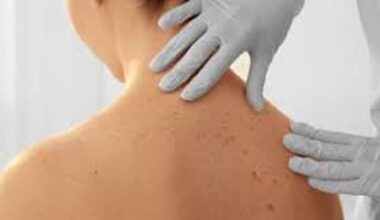 «Visita dermatologica periodica, il Servizio Sanitario Regionale la renda garantita»