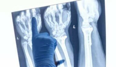 Cina, «una “colla per ossa” per curare le fratture in 3 minuti» (senza intervento chirurgico): ecco come funziona