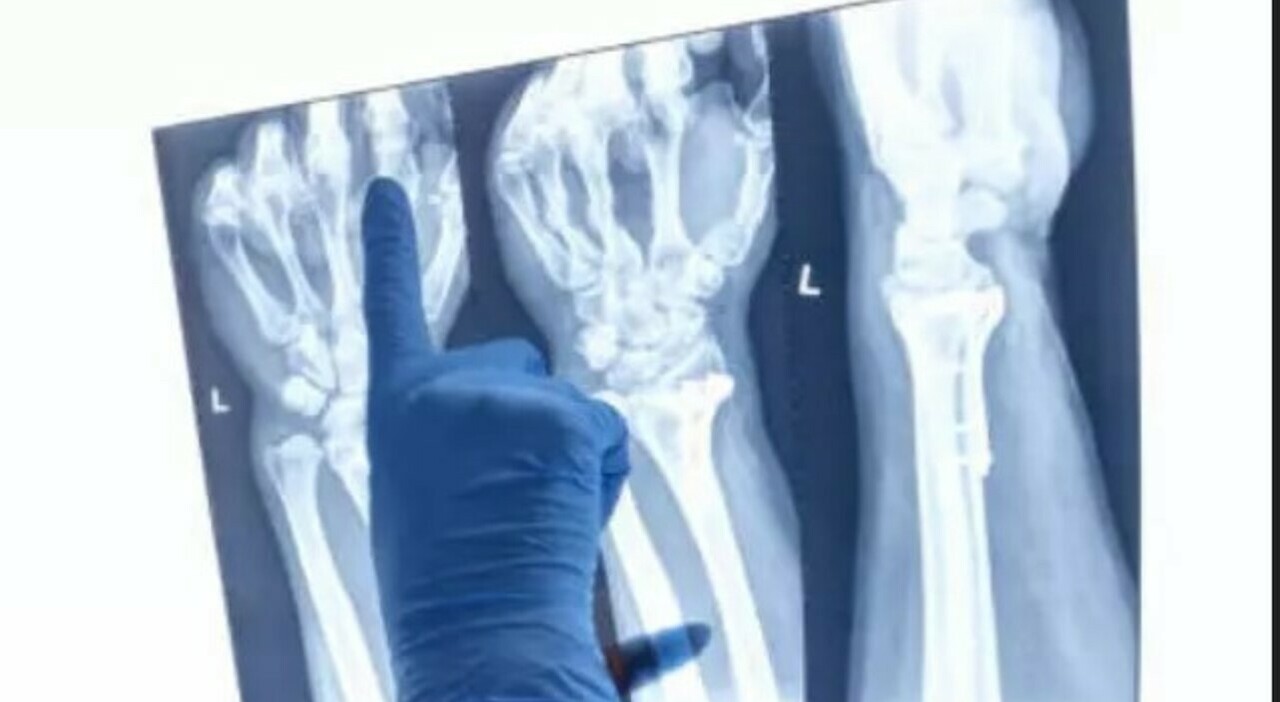 Cina, «una “colla per ossa” per curare le fratture in 3 minuti» (senza intervento chirurgico): ecco come funziona