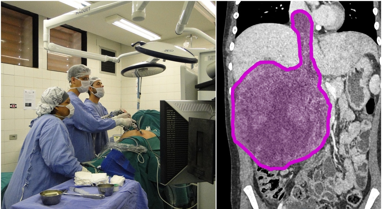 Ultrasuoni contro il tumore, la scoperta casuale che sta rivoluzionando la medicina: cosa è l'istotripsia