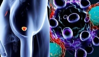 «Stavo bene, non avevo nessun sintomo e non mi sono controllato. Ora ho un tumore alla prostata. Non fate i miei stessi errori»