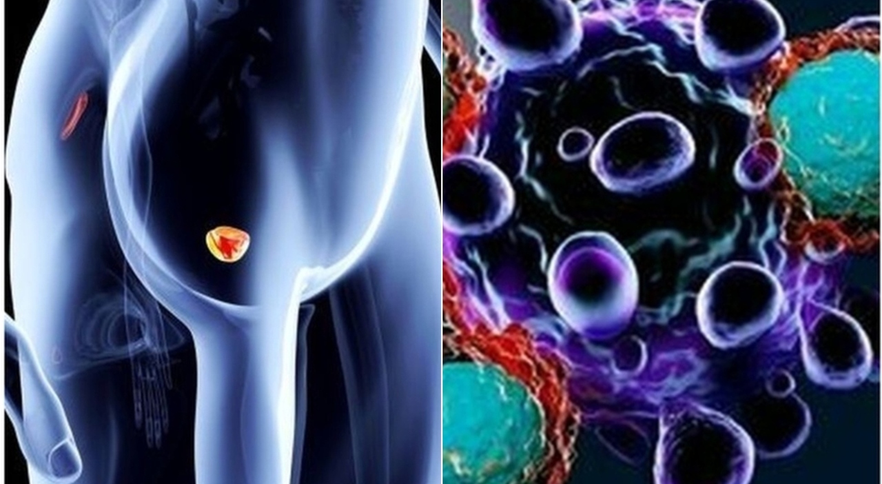 «Stavo bene, non avevo nessun sintomo e non mi sono controllato. Ora ho un tumore alla prostata. Non fate i miei stessi errori»