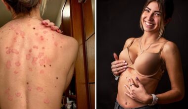 «A 11 anni la diagnosi di psoriasi. Da adolescente mi nascondevo, poi ho capito che è un punto di forza: le imperfezioni ci rendono unici» - Leggo.it