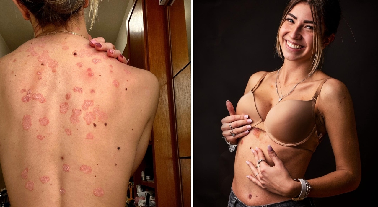 «A 11 anni la diagnosi di psoriasi. Da adolescente mi nascondevo, poi ho capito che è un punto di forza: le imperfezioni ci rendono unici» - Leggo.it