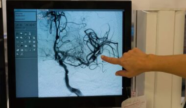 Salute, ictus: i 6 campanelli d’allarme da non ignorare e le regole per prevenirlo