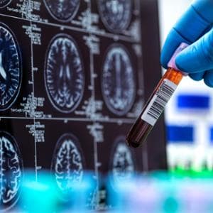Diagnosticare l’Alzheimer con un test del sangue: a che punto siamo?