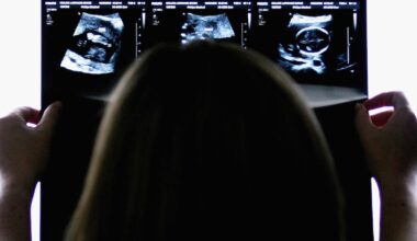 Non sapere di essere incinte, fino al parto