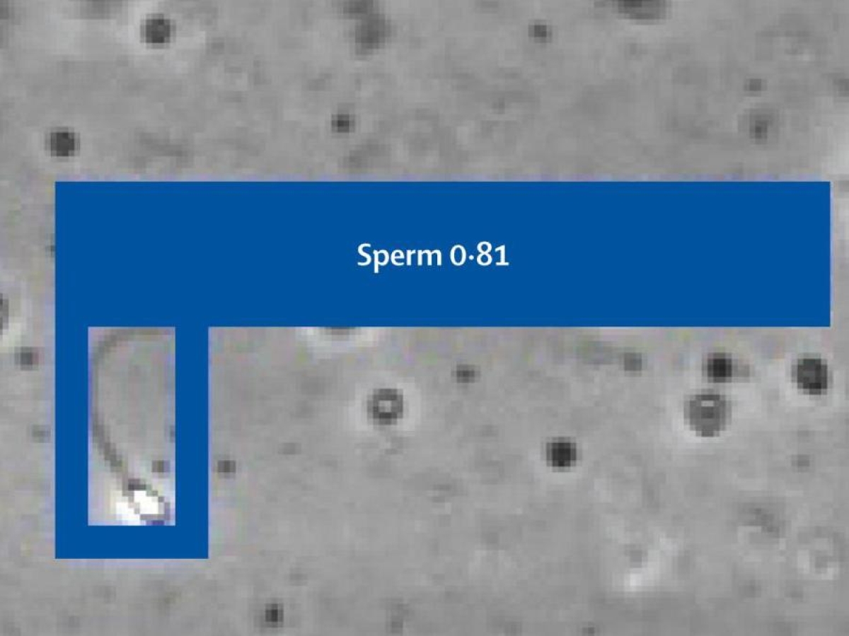 La prima gravidanza con l'Intelligenza artificiale: «Ha trovato gli unici due spermatozoi "attivi" di un 39enne e 13 giorni dopo la compagna era incinta»