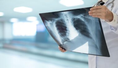 Peppe Vessicchio morto per polmonite interstiziale: sintomi e cure