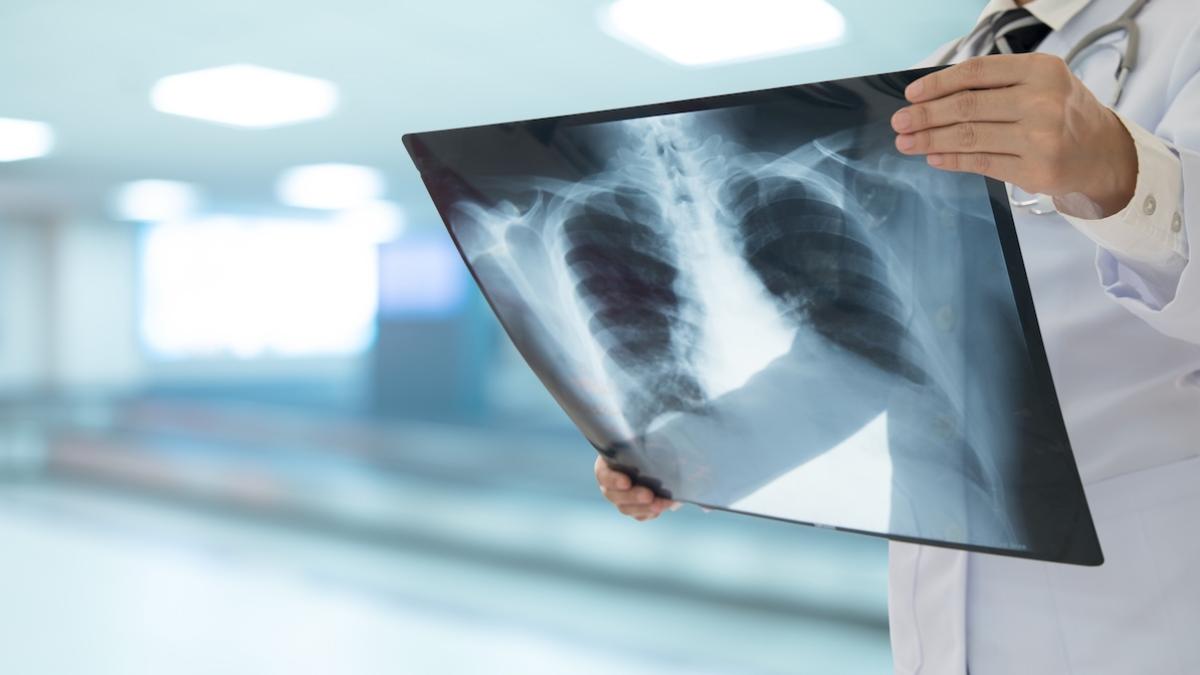 Peppe Vessicchio morto per polmonite interstiziale: sintomi e cure