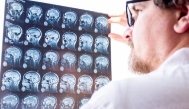 Sclerosi multipla, da una proteina prodotta nel cervello un possibile marcatore di gravità della malattia