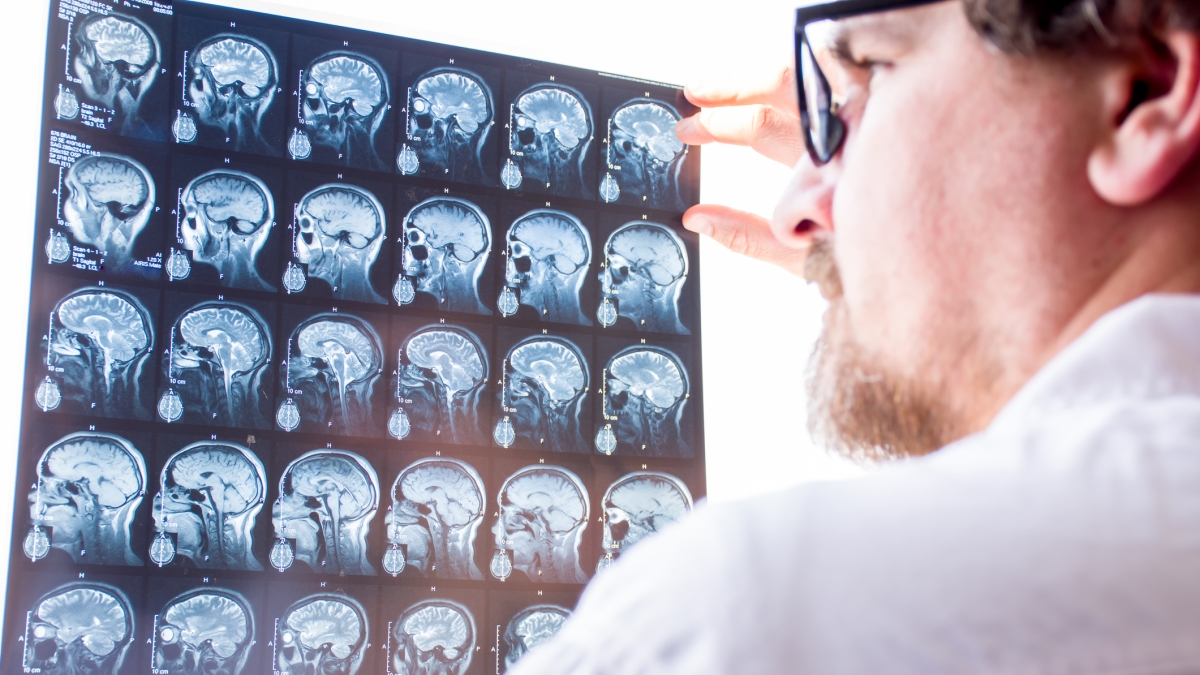 Sclerosi multipla, da una proteina prodotta nel cervello un possibile marcatore di gravità della malattia