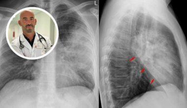 «Ospedali già pieni». Sintomi, cause, cure e cosa non fare