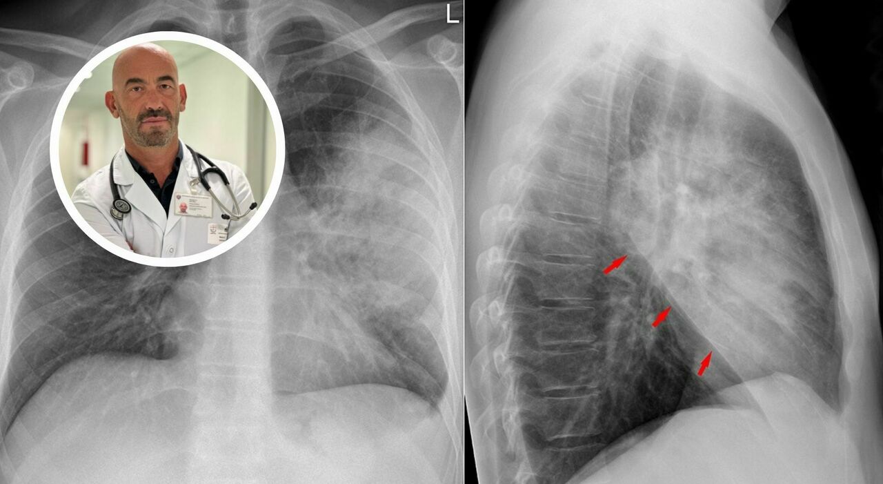 «Ospedali già pieni». Sintomi, cause, cure e cosa non fare