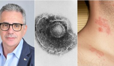 «Attenzione agli occhi». Sintomi, cause, cure e come avviene il contagio