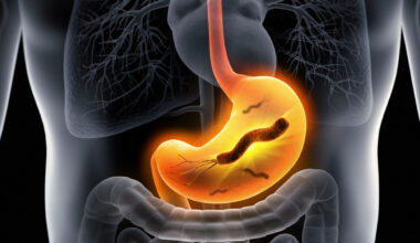 Helicobacter pylori, il killer silenzioso colpisce il 40% della popolazione italiana: i sintomi e quanto è pericoloso