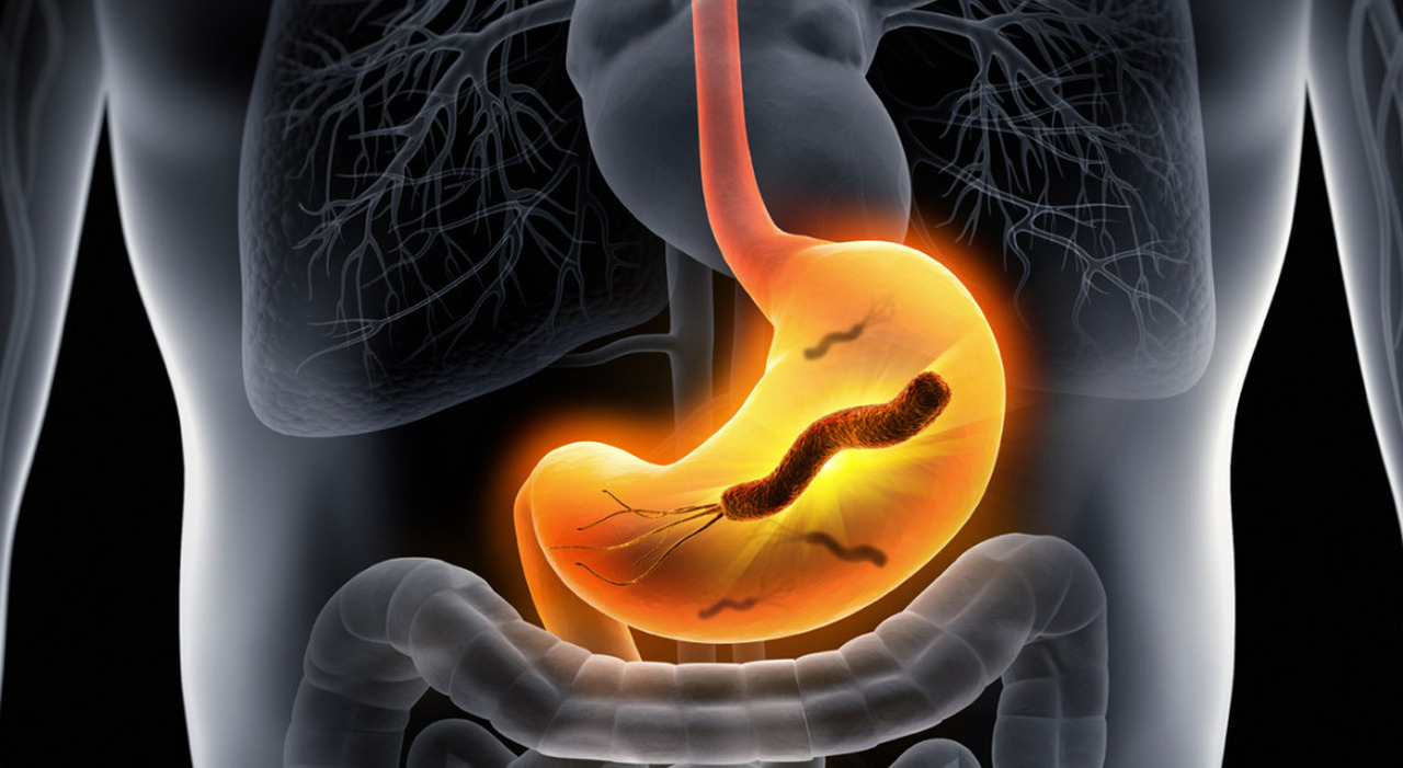 Helicobacter pylori, il killer silenzioso colpisce il 40% della popolazione italiana: i sintomi e quanto è pericoloso
