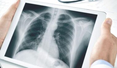 Polmonite interstiziale: sintomi, rischi e cure spiegate