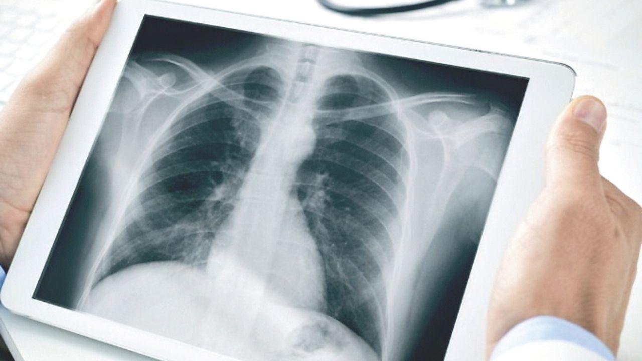 Polmonite interstiziale: sintomi, rischi e cure spiegate